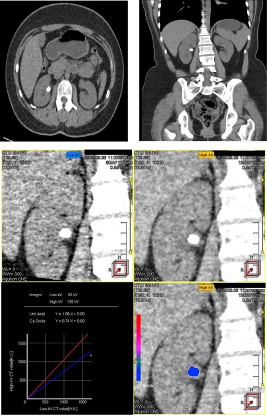 Dual Energy KUB Imaging